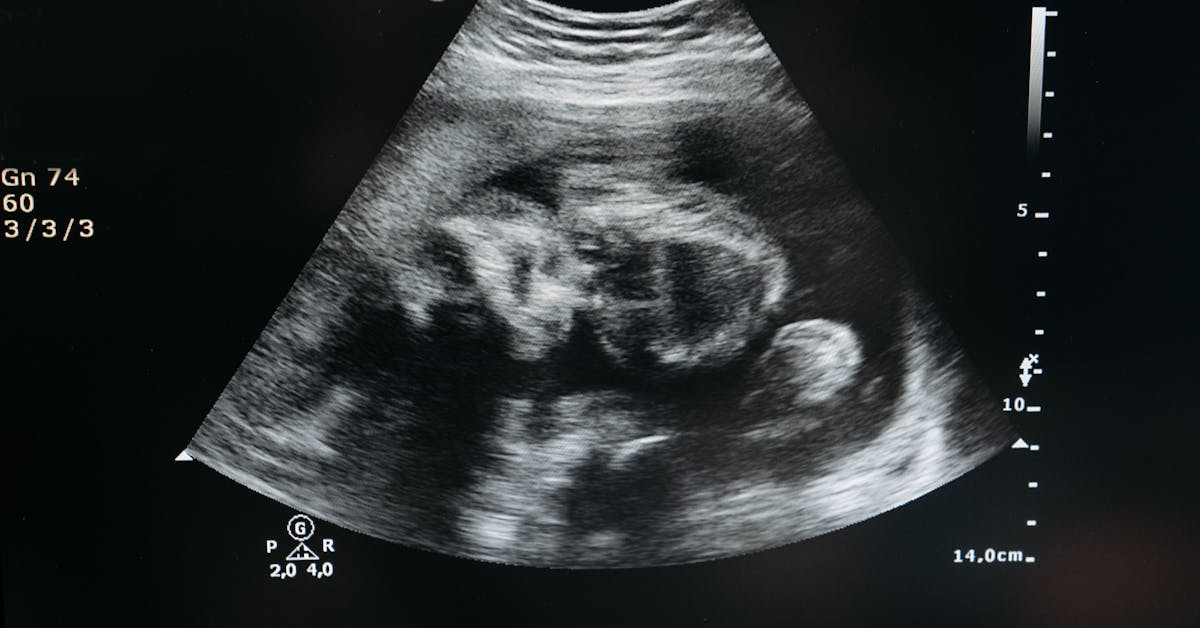 Ultrassom de gestação inicial mostrando bebê na fase de fechamento do tubo neural